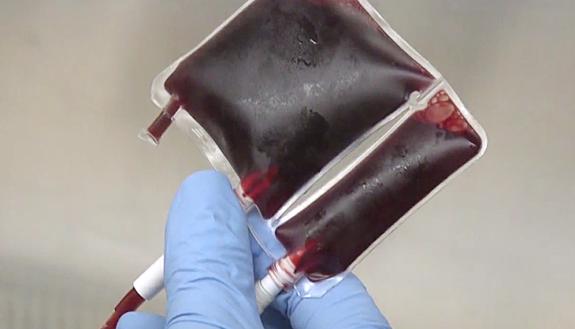 Technique addresses some risks of bone marrow transplants using umbilical cord blood
