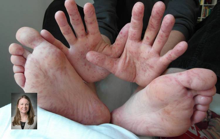 Amanda Hargrove. Hand, foot and mouth disease in an adult