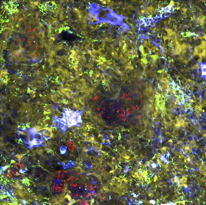 A stained section of lung tissue taken from mice infected with a tuberculosis-like bacteria and treated with an MMP inhibitor shows more stable blood vessels (blue) and a decrease in leaking blood (red) within the granulomas (dark, circular shadows)