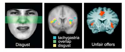 Pearson brain study