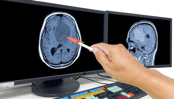 brain scans of tumor patient