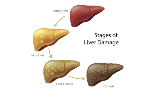 Stages of liver disease: Healthy to fatty to liver fibrosis to cirrhosis