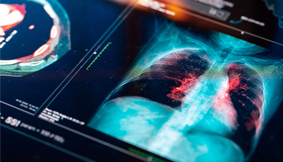 X-ray of lungs