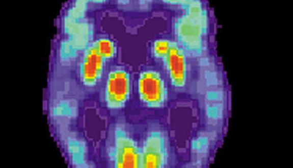 Positron Emission Tomography scan of a brain affected by cognitive declines . (NIH