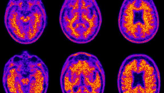 amyloid plaques