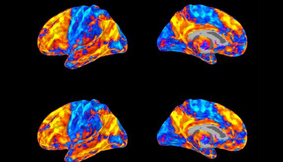Four MRI scans of a brain in multiple colors