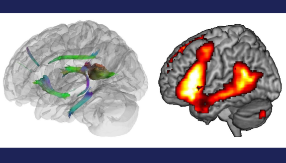 brain scans showing impact of alzheimer's