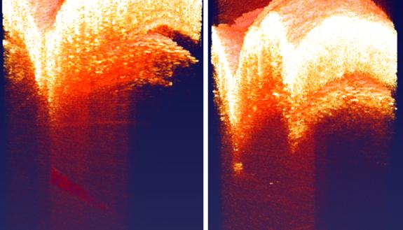 A new “dual-axis” approach to OCT allows researchers to look deeper beneath biological tissue. Here, a needle point more than one millimeter beneath a mouse’s skin can be seen toward the bottom of the dual-axis image (left) but not in the standard image (