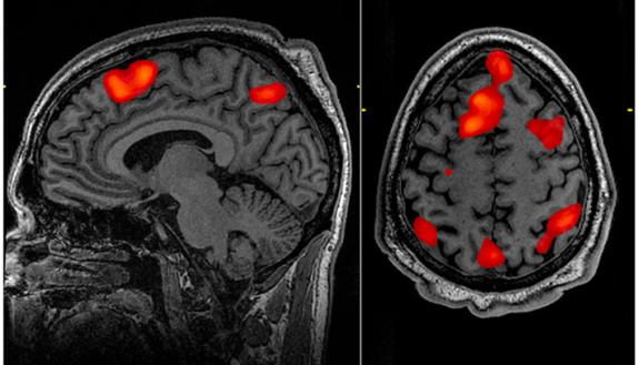 A functional MRI scan of a brain during working memory tasks, showing activity in the bilateral and superior frontal cortex as well as the superior bilateral parietal cortex. Credit - John Graner, Walter Reed National Military Medical Center