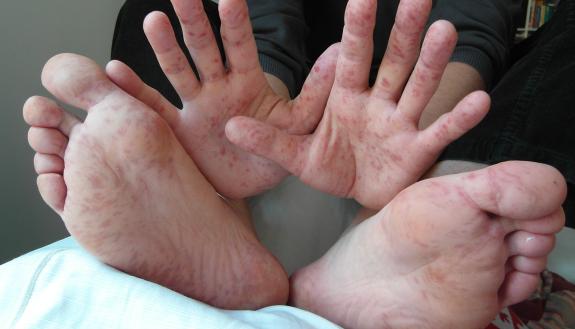 Duke researchers have identified a potential drug candidate against enterovirus 71, a common cause of hand, foot and mouth disease in infants and young children. Credit: Wikimedia Commons.