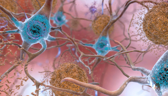 plaques in the brain connected to Alzheimer's
