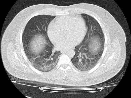 A cross-sectional image of the damaged lungs of a COVID-19 patient on a CT scan. Case courtesy of Dr Fateme Hosseinabadi , Radiopaedia.org, rID: 74868. 