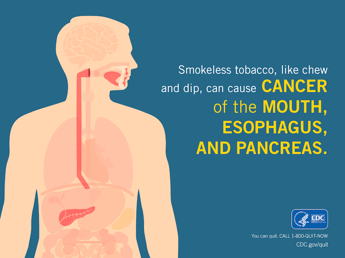 An infographic shows where smokeless tobacco can cause cancer in the body. Image courtesy of the Centers for Disease Control and Prevention.