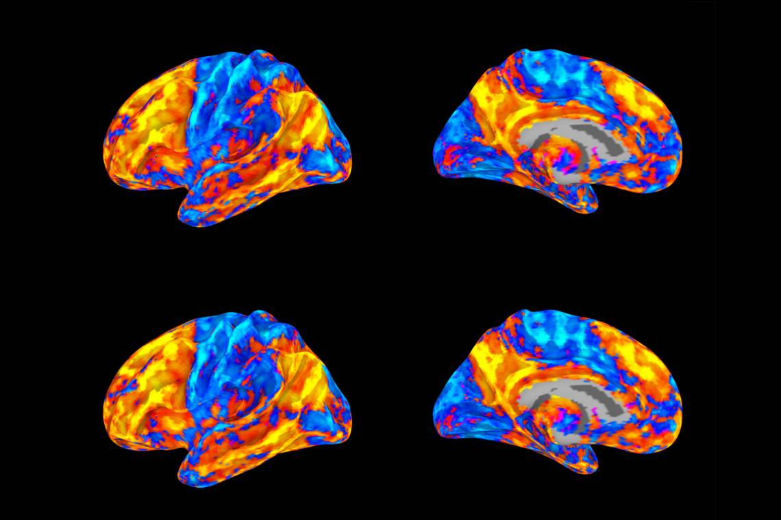 Breakdown of Brain's Visual Networks Linked to Mental ...