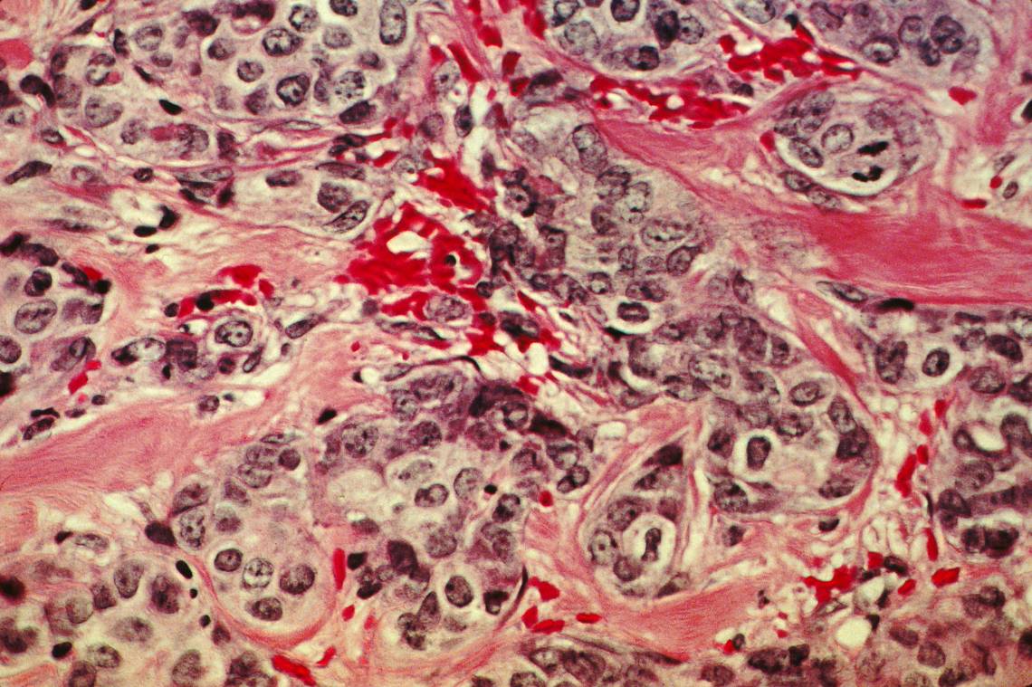 In this microscope view of cancerous tissue, purple-colored breast cancer cells are nestled within ribbons of pink connective tissue. Credit: Dr. Cecil Fox, National Cancer Institute, NIH.