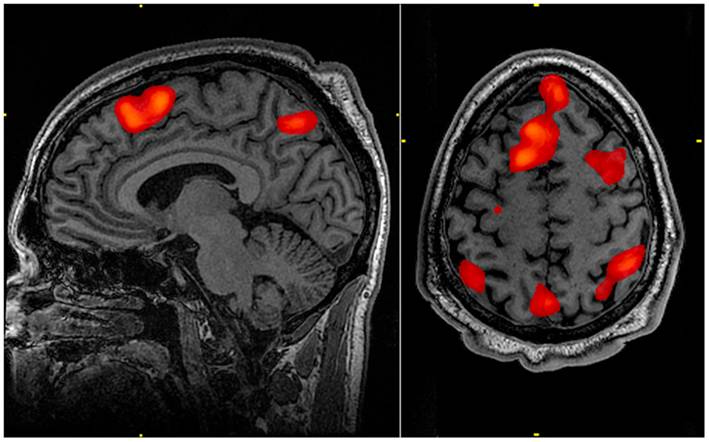 A functional MRI scan of a brain during working memory tasks, showing activity in the bilateral and superior frontal cortex as well as the superior bilateral parietal cortex. Credit - John Graner, Walter Reed National Military Medical Center