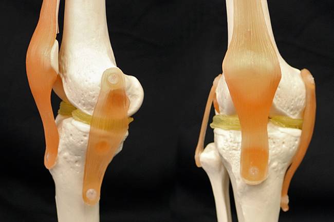 A plastic model of a knee with 3-D-printed menisci.    