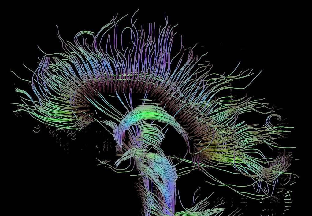 An MRI technique called diffusion tensor imaging traces the bundles of nerve fibers that carry electrical signals between different areas of the brain. Image by Thomas Schultz, Wikimedia Commons
