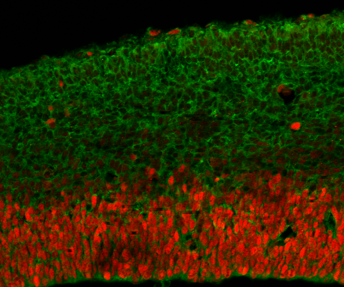 Genetic samples from developmentally disabled children have identified dozens of new mutations in the DDX3X gene that lead to smaller brains and intellectual disability because of the gene's role in neuron genesis and transport. Credit: Silver Lab.