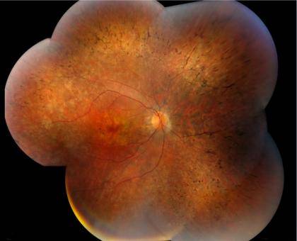 A composite image of the human retina shows diffused pigmentary retinal degeneration. Photo credit – Ziqiang Guan, Duke University Medical Center Funder: NIH (R01EY018586; P30-EY014801; LIPID MAPS Collaborative Grant GM-069338); Department of Defense (