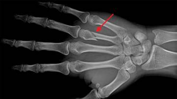 Hand X-Ray showing broken bone